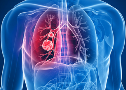 肺里吸入异物怎么办 肺里吸入异物怎么办