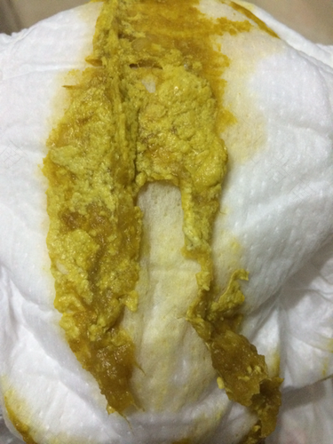 一天多次大便是怎么回事? 一天多次大便是怎么回事?