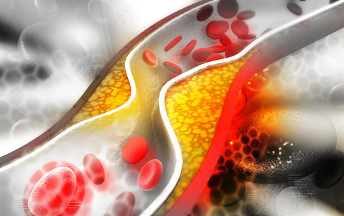 早期动脉硬化怎么治