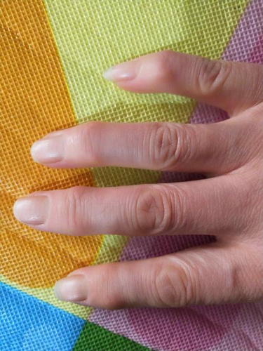 手指关节肿大看什么科室 手指关节肿大看什么科室