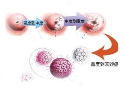 子宫癌需要怎么治疗 子宫癌需要怎么治疗