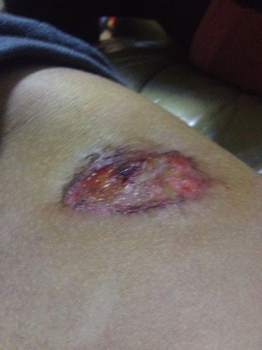 擦伤怎么处理伤口 擦伤怎么处理伤口