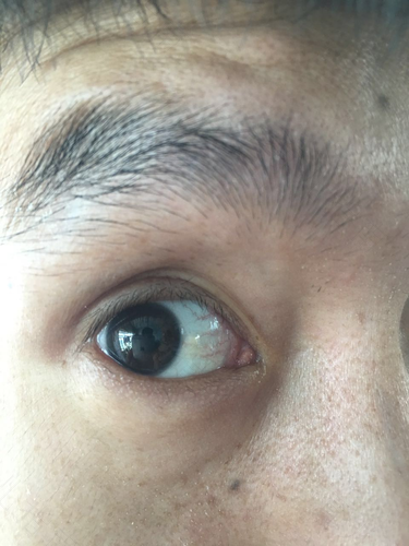 孩子白眼球发红是怎么回事 孩子白眼球发红是怎么回事