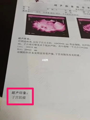 宫颈囊肿大了不做手术会怎么样