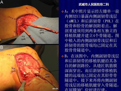 膝关节部分韧带撕裂怎么办 膝关节部分韧带撕裂怎么办