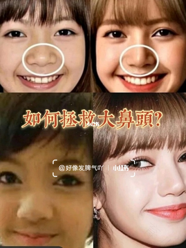 鼻子太大怎么办想变小怎么办 鼻子太大怎么办想变小怎么办