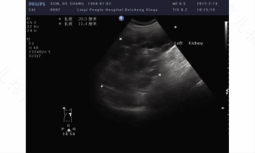 多囊肾会引起高血压吗