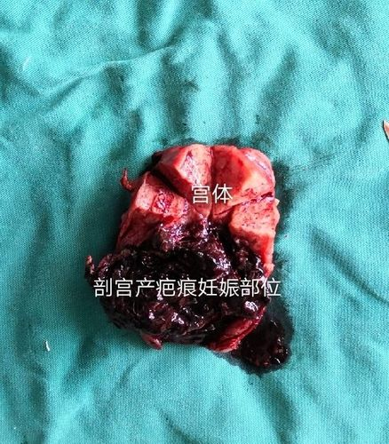 子宫内残留物机化怎么办 子宫内残留物机化怎么办