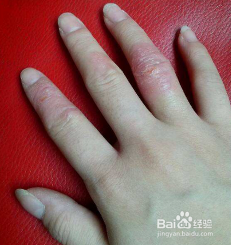 手发麻发胀怎么办偏方 手发麻发胀怎么办偏方