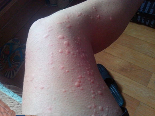 过敏性荨麻疹多久能好 过敏性荨麻疹多久能好