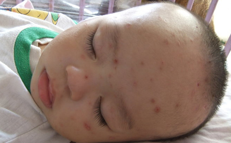 小孩起水痘发烧怎么办怎样退烧快