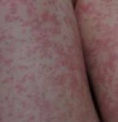 皮肤过敏引起发烧怎么办