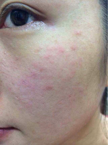 脸上痒怎么办? 脸上痒怎么办?