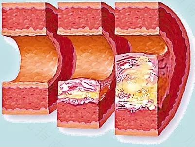 重度脑动脉硬化怎么办 重度脑动脉硬化怎么办