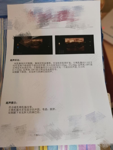 结核性脓肿能治好吗 结核性脓肿能治好吗