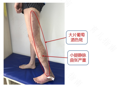 轻微的静脉曲张怎么办?