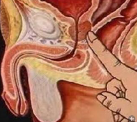 息肉痔疮怎么治疗 息肉痔疮怎么治疗