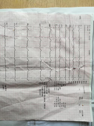 心脏过早复极有危险吗 心脏过早复极有危险吗
