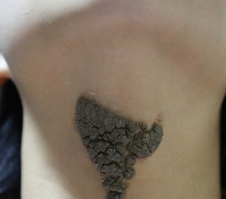 切痣手术后不能吃什么 切痣手术后不能吃什么