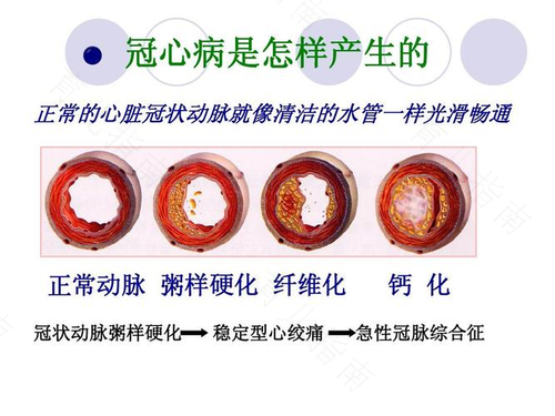 冠心病前期怎么治疗 冠心病前期怎么治疗