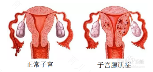 子宫腺肌症吃什么食物好不再发 子宫腺肌症吃什么食物好不再发
