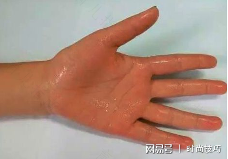 手掌爱出汗怎么办 手掌爱出汗怎么办