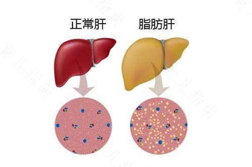 脂肪肝如何消除食疗法 脂肪肝如何消除食疗法
