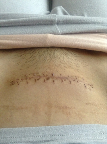 剖腹产伤口多久能长好? 剖腹产伤口多久能长好?