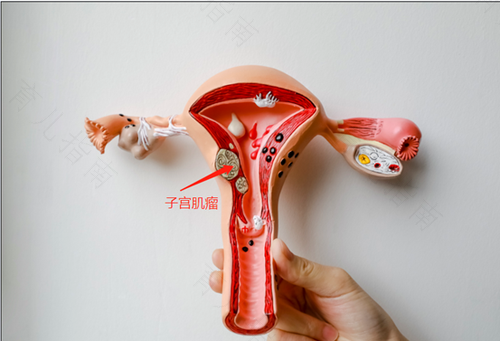 子宫后壁肌瘤怎么形成的
