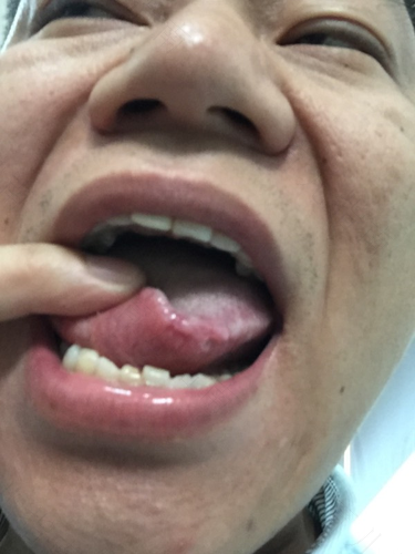 舌头经常溃疡怎么办? 舌头经常溃疡怎么办?