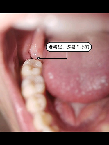 拔牙一周了还疼正常吗 拔牙一周了还疼正常吗