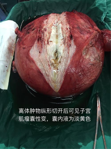 子宫后方囊性结节什么意思