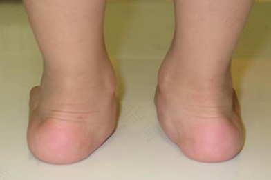 扁平足后天是怎么形成的 扁平足后天是怎么形成的