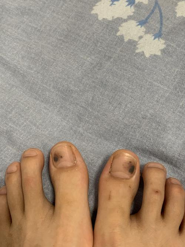 脚趾下有黑点怎么回事 脚趾下有黑点怎么回事