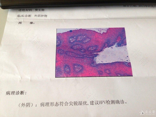 怀孕三个月得了尖锐湿疹怎么办 怀孕三个月得了尖锐湿疹怎么办