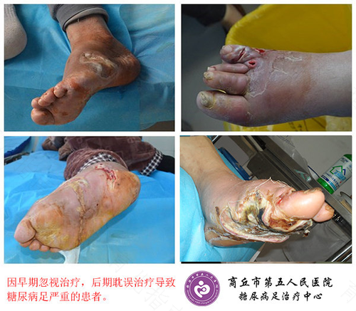 糖尿病患者脚麻怎么办? 糖尿病患者脚麻怎么办?