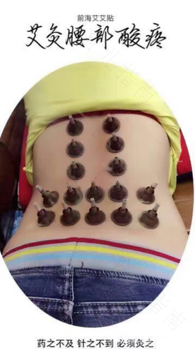 艾灸对腰椎间盘突出有好处吗 艾灸对腰椎间盘突出有好处吗