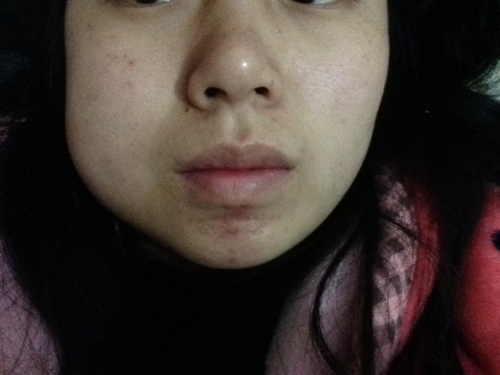 拔完牙脸肿多久会消除 拔完牙脸肿多久会消除