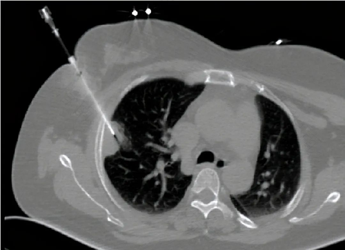 老人做肺穿刺危险吗