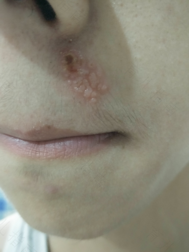 宝宝上火鼻子烂了怎么办