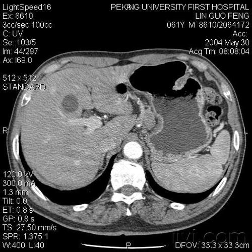 派克ct可以检查肠胃吗 派克ct可以检查肠胃吗