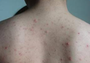 后背长暗疮怎么办 后背长暗疮怎么办