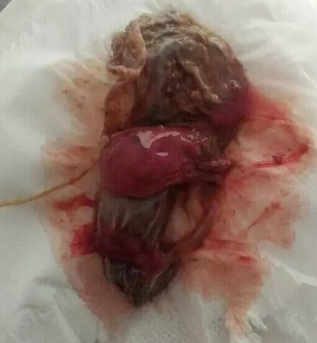 子宫糜烂的症状和治疗 子宫糜烂的症状和治疗