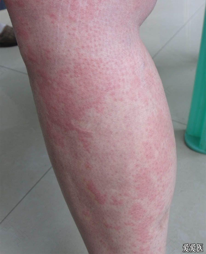 慢性荨麻疹会传染别人吗 慢性荨麻疹会传染别人吗