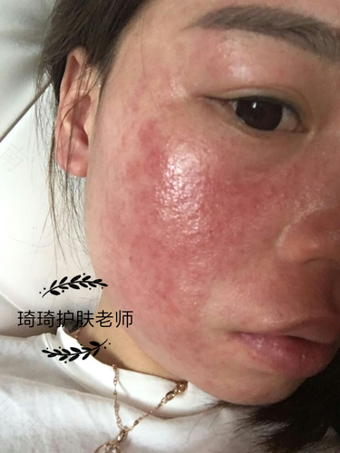 断激素过敏症多久恢复 断激素过敏症多久恢复