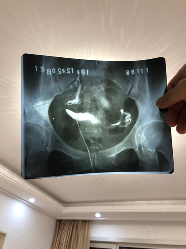 盆腔炎能做输卵管造影检查吗 盆腔炎能做输卵管造影检查吗