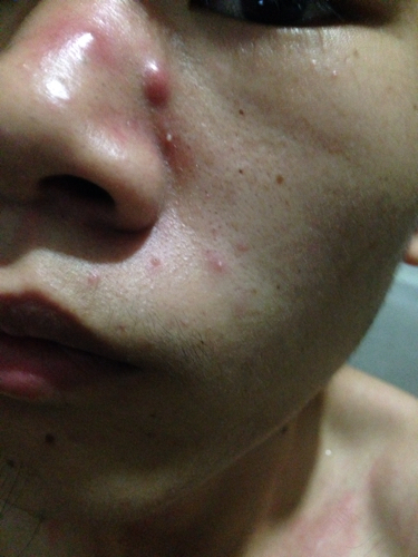 鼻子撞到了墙上一直疼怎么办 鼻子撞到了墙上一直疼怎么办