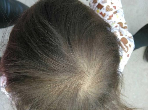 头顶很多白头发怎么办 头顶很多白头发怎么办