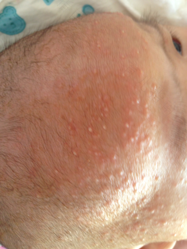 严重湿疹怎么办? 严重湿疹怎么办?