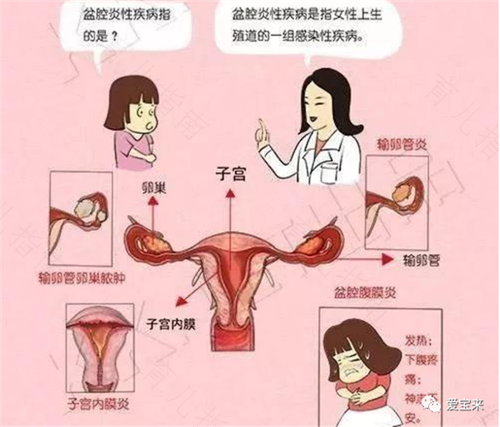 急性盆腔炎会发烧吗 急性盆腔炎会发烧吗